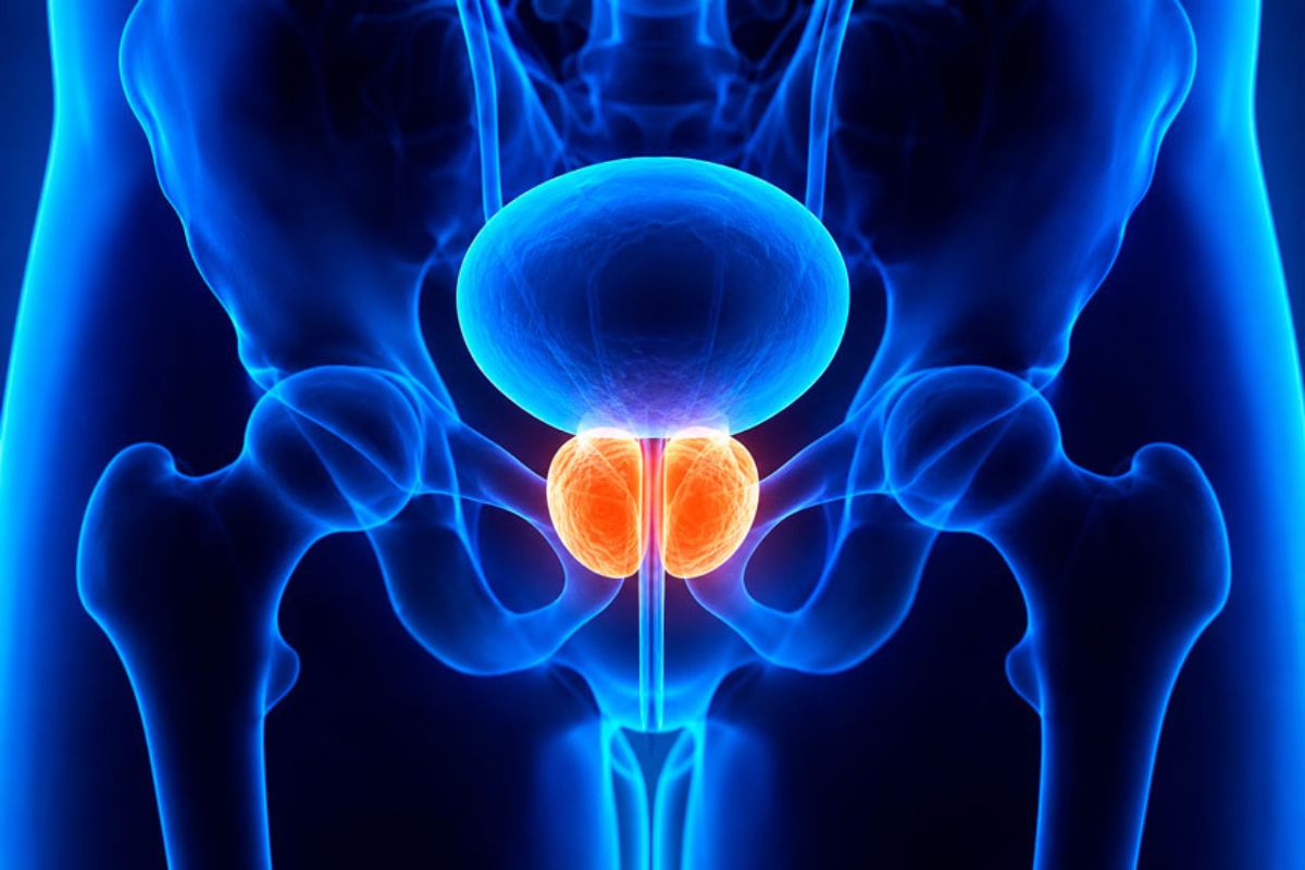 Cáncer de Próstata en Naucalpan
